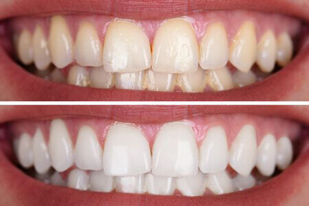 Teeth whitening treatment before and after