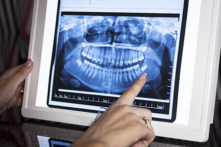 Dental X-Ray