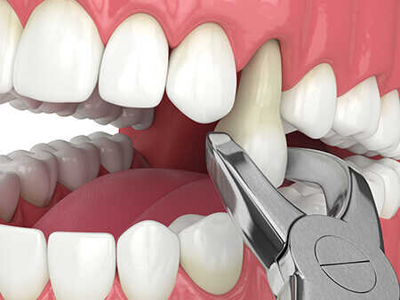 3d modeling of a tooth extraction
